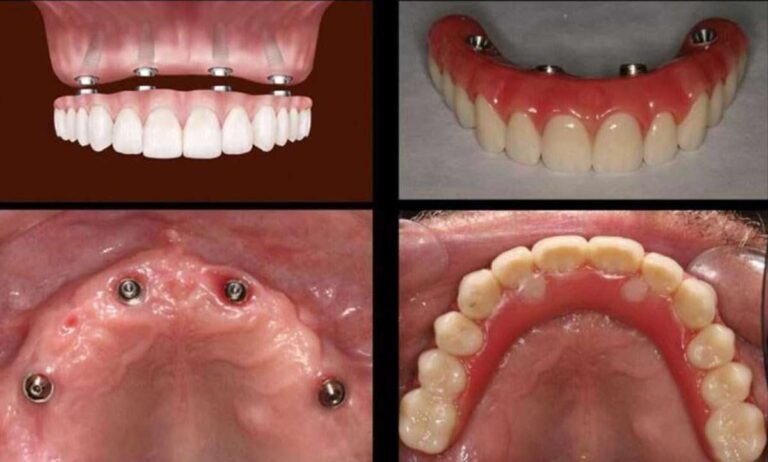 All-on-4 Implant