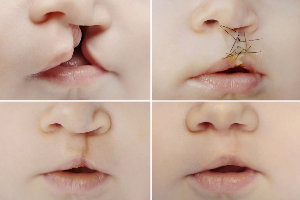 Cleft Lip & Palate surgery