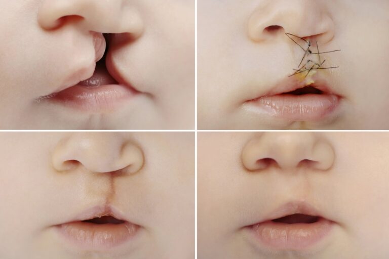 Cleft Lip & Palate surgery