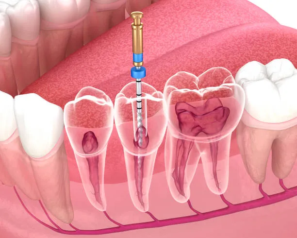 Endodontics