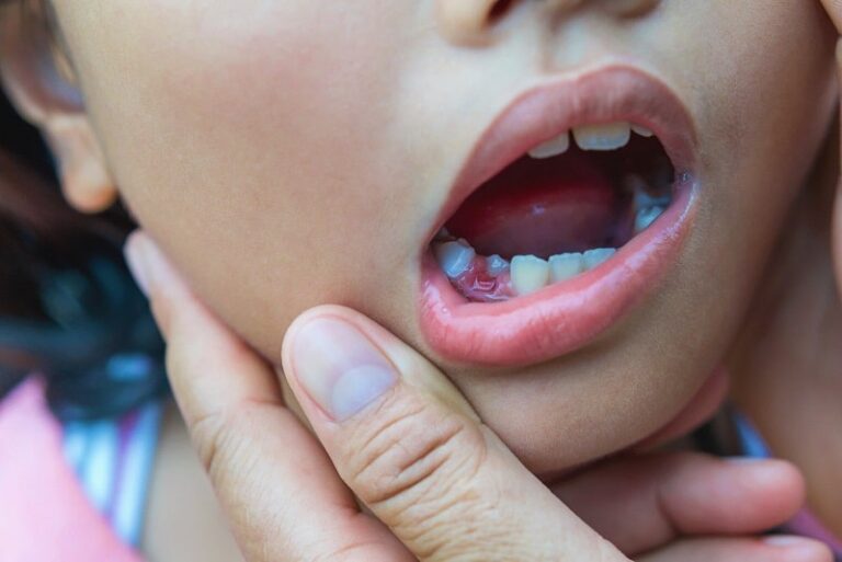 Pediatric Root canal treatment