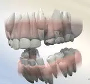Serial extractions 1 Serial extractions