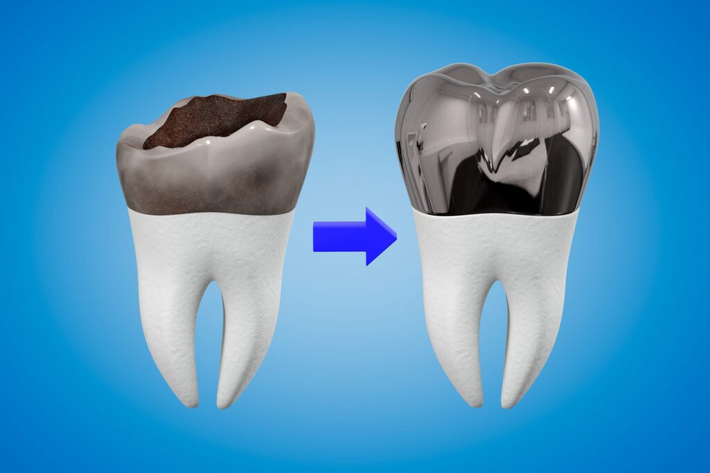 Stainless steel crowns