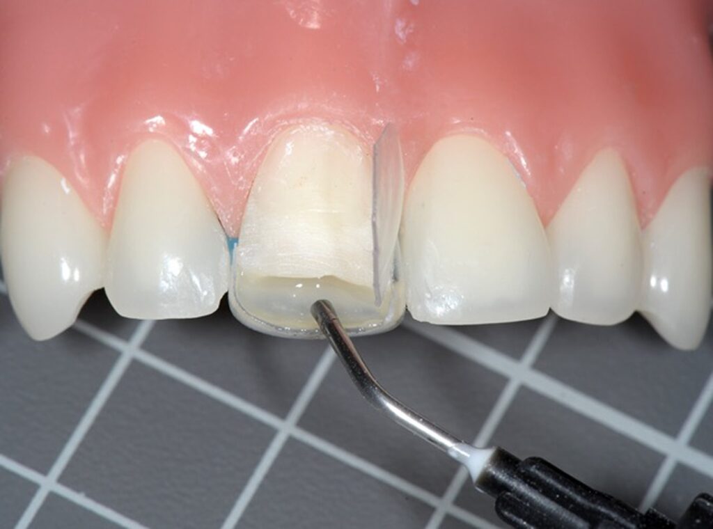 Strip crowns