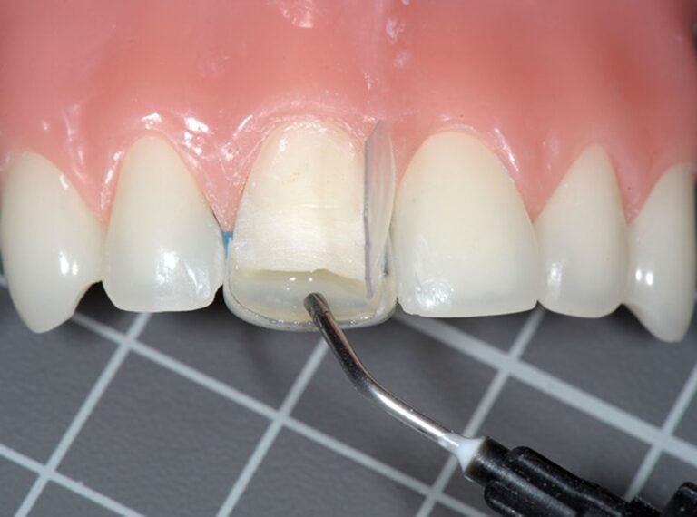 Strip crowns