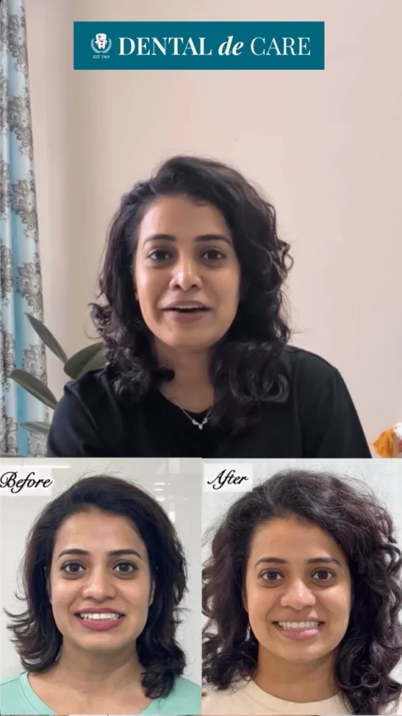 apoorva invisalign story 1