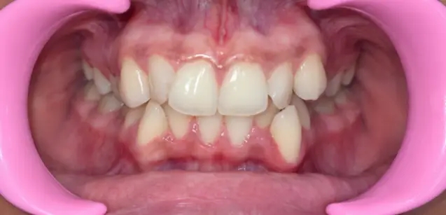 Case Study: Invisalign Treatment for Severe Dental Crowding in a 13-Year-Old 3 dental crowding before front