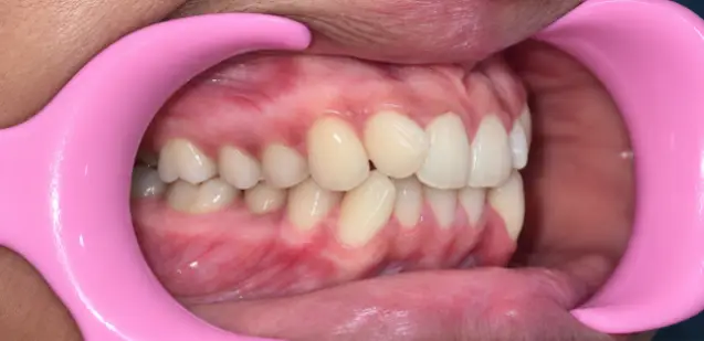 Case Study: Invisalign Treatment for Severe Dental Crowding in a 13-Year-Old 2 dental crowding before left