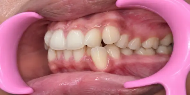 Case Study: Invisalign Treatment for Severe Dental Crowding in a 13-Year-Old 4 dental crowding before right