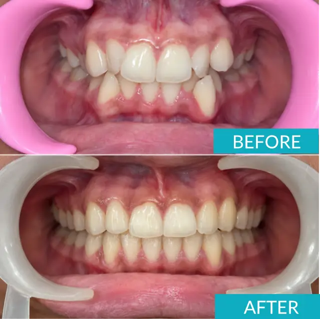 Case Study: Invisalign Treatment for Severe Dental Crowding in a 13-Year-Old 7 dental crowding front before after 1