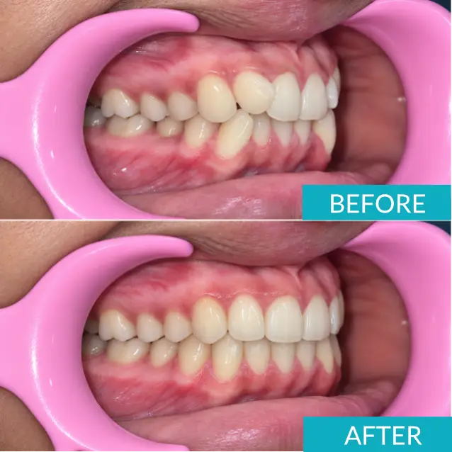 Case Study: Invisalign Treatment for Severe Dental Crowding in a 13-Year-Old 6 dental crowding left before after 1