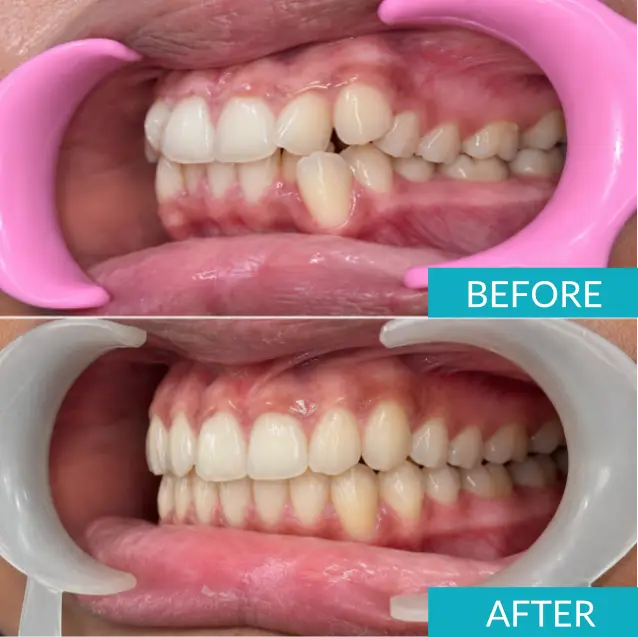 Case Study: Invisalign Treatment for Severe Dental Crowding in a 13-Year-Old 8 dental crowding right before after 1