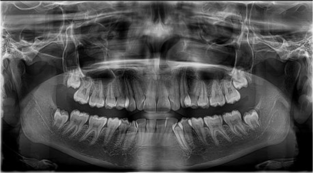 Case Study: Invisalign Treatment for Severe Dental Crowding in a 13-Year-Old 1 dental crowding xray indirangar